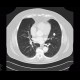 Chondrohamartoma of lingula, lung: CT - Computed tomography